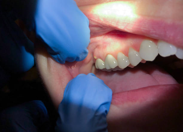 Best Emergency Dental Filling Replacement  in Woodsville, NH